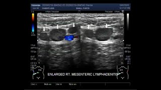 Ultrasound Video showing Mesenteric lymphadenitis enlarged mesenteric lymph nodes [upl. by Ynoep]