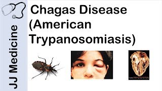 Chagas Disease  American Trypanosomiasis  Causes Symptoms and Treatment [upl. by Dunlavy]