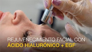 Rejuvenecimiento Facial con Ácido Hialurónico  EGF [upl. by Enirahtak483]