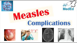 Measles Signs amp Symptoms Microbiology Diagnosis Treatment and Prevention [upl. by Ynnal]