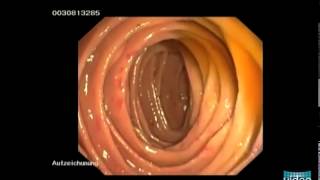 Hereditary Hemorrhagic Telangiectasia OslerWeberRendu Disease [upl. by Aynor638]