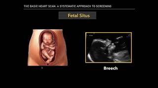 The Basic Fetal Heart Scan [upl. by Lacym]