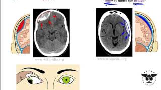 Hemorrhagic Stroke  Intracerebral Hemorrhage amp Subarachnoid Hemorrhage  Management [upl. by Ahsitil]