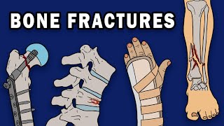 BONE FRACTURES [upl. by Redan]