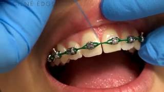 Flossing Braces With a Threader [upl. by Adnawuj]