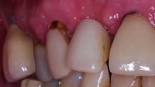 Cariology Part 7 Types of Caries [upl. by Basham572]