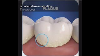 Stage 1 of Tooth Decay Demineralization [upl. by Koenraad]