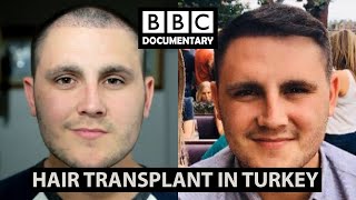 Hair Transplant Turkey  BBC Documentary  Paul Before amp After [upl. by Korella530]