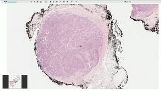 Glomus Tumor  Histopathology [upl. by Akilegna]