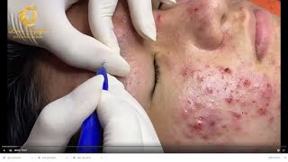 Treatment of acne tablets pustules and blackheads 359  Loan Nguyen [upl. by Warton]