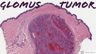 Imaging brain tumors  3  Oligodendrogliomas [upl. by Kailey971]