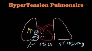 What Is Pulmonary Arterial Hypertension  WebMD [upl. by Leggat]