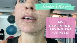 MY EXPERIENCE  Vi Peel For Hyperpigmentation Melasma [upl. by Inail]