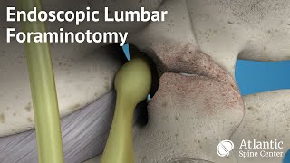 Endoscopic Lumbar Foraminotomy [upl. by Lubeck11]