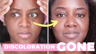 How I Got Rid of My Dark Circles Black Skin [upl. by Sell230]