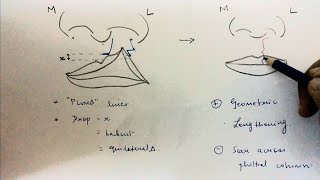 Cleft lip part 3  Triangular flap [upl. by Hubing]