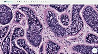 Cylindroma  Histopathology [upl. by Glaser167]