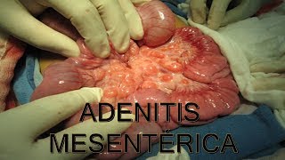 ADENITIS MESENTERICA  MEDICINA HUMANA  MediCiencia [upl. by Malarkey]