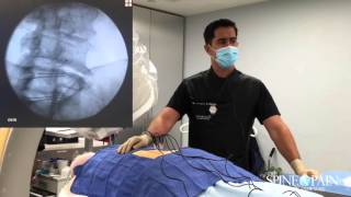 Radiofrequency Ablation Procedure [upl. by Anyt445]