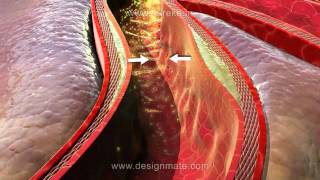 Assista a aula sobre Aterosclerose simulada na nova Lousa 3D Estereoscópico [upl. by Grey]