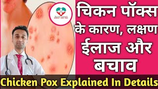 Chicken Pox in hindi Chicken pox Symptoms  DrKSChougule [upl. by Suez]