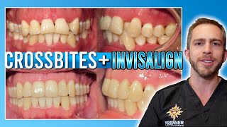 Invisalign Crossbite Treatment BEFORE amp AFTER [upl. by Shig59]