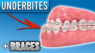 How Do Braces Fix Underbites  Premier Orthodontics [upl. by Ennelram]