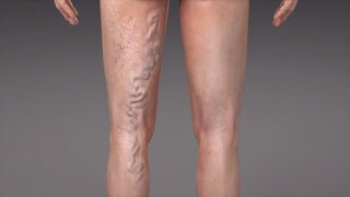 Stages of Varicose Veins [upl. by Lupita]