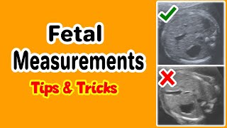 Fetal Measurements Tips and Tricks [upl. by Shutz]