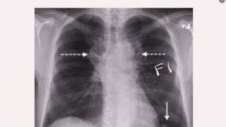 CXR in PE [upl. by Sillad]