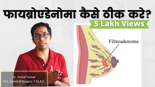 Breast Fibroadenoma explained in Hindi  Dr Vishal Tomar  Open Consult [upl. by Noble]