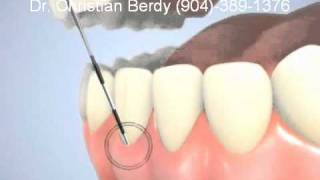 Periodontal Exam  Jacksonville FL [upl. by Ettevroc746]