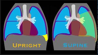 Radiology of Spine Trauma [upl. by Ethelinda]