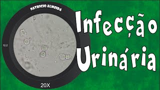 Infecção urinária  Piúria bactérias e muco [upl. by Asyral]