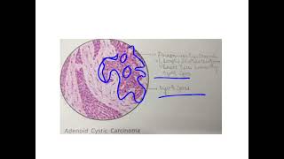 Adenoid cystic carcinoma [upl. by Lohner47]