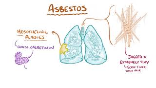 Mesothelioma causes symptoms diagnosis treatment pathology [upl. by Stark]