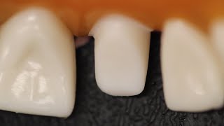 All Ceramic Crown Anterior Tooth Preparation [upl. by Garcia]