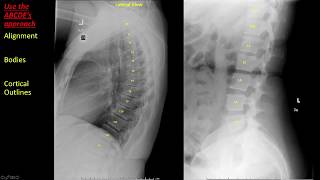 Introduction to Spine Radiographs [upl. by Lanuk773]