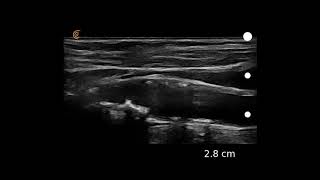 Carotid Duplex Exam [upl. by Anerac]