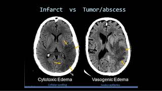 Radiological Diagnosis and Approach to Leukodystrophies [upl. by Adriana]