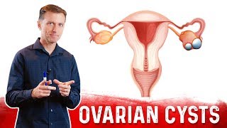 Ovarian Cysts Causes Symptoms amp Natural Treatment – DrBerg [upl. by Nydia857]