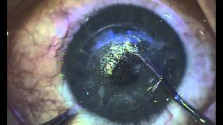 LASIK Surgery and its Risks [upl. by Jaclyn]