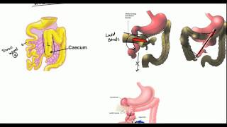 Gut Malrotation Nonrotation and Volvulus for USMLE [upl. by Cummine]