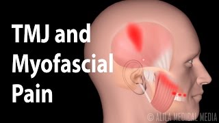 TMJ and Myofascial Pain Syndrome Animation [upl. by Ahsinak]