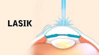 How LASIK Eye Surgery Is Performed [upl. by Iat]