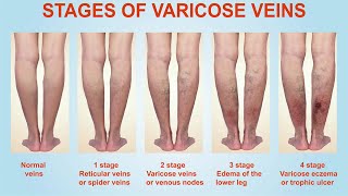 Treatment for Varicose Veins  Nucleus Health [upl. by Dempsey898]