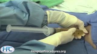 Paracentesis Procedure Video Trailer [upl. by Llevad989]