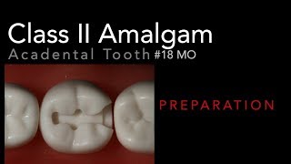 Class II Amalgam Preparation  18 MO Acadental Typodont [upl. by Matthias]