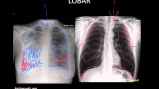 Pneumonia Imaging [upl. by Ellehsyt]