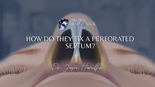 How do they fix a perforated septum [upl. by Stoneman]